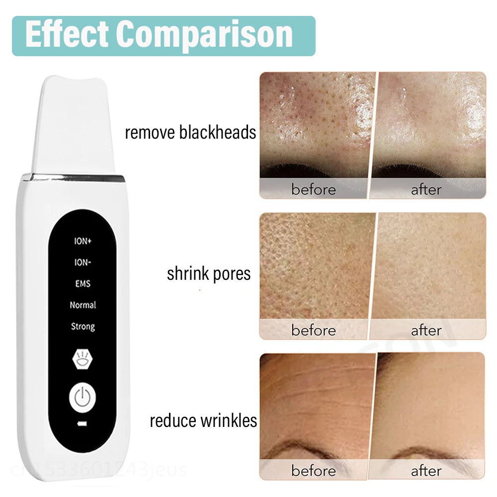 Glammry™ Heated Ultrasonic Skin Scrubber